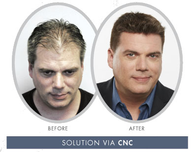 CNC3D Hair Loss Solutions