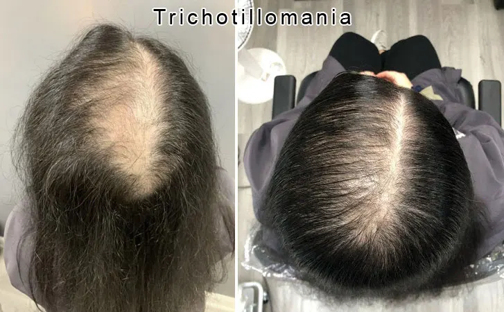 Trichotillomania Causes Symptoms Treatment